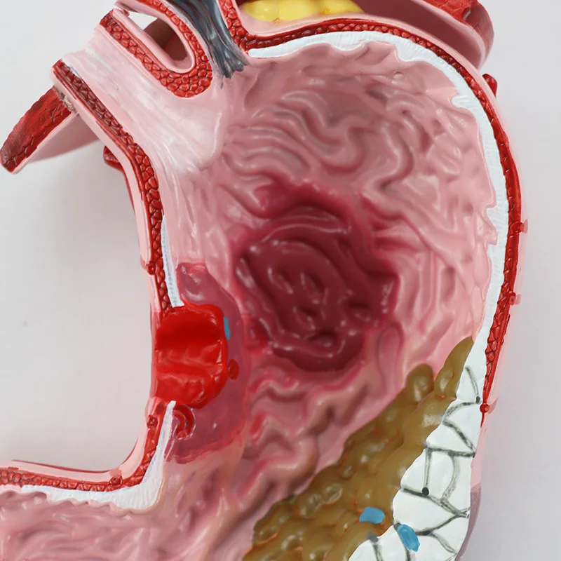 Diseased Stomach Model with Diaphragm Demonstration Anatomy Model Pathological Stomach Model