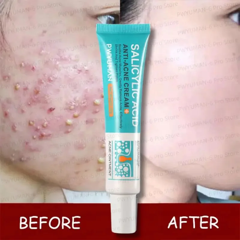 Salicylic Acid Acne Treatment Face Cream Repair Pimple Spots Deep Cleaning Pore Anti-acne Scar Oil Control Moisturizer Skin Care