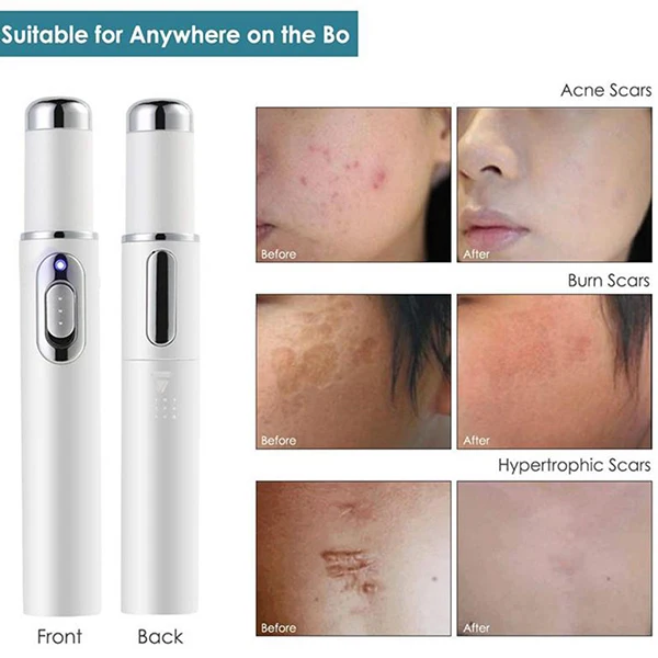 

Portable Acne Treatment Pen Activates The Skin & Tightens Loose Skin for Your Wife,Girlfriend,Mother & Sister