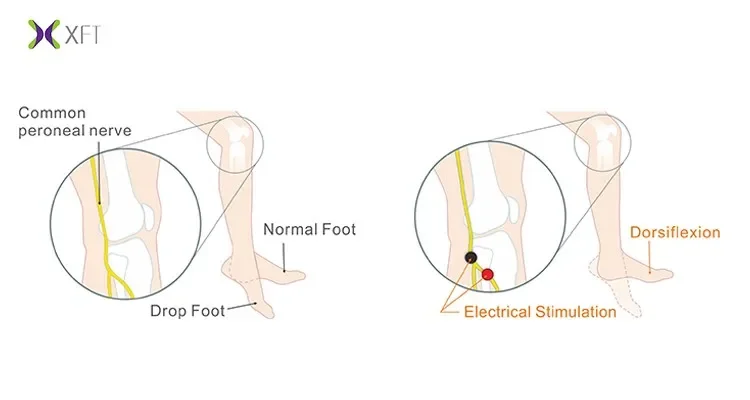 Sistema G4 basato su stimolazione FES per la caduta del piede neuromuscolare indossabile