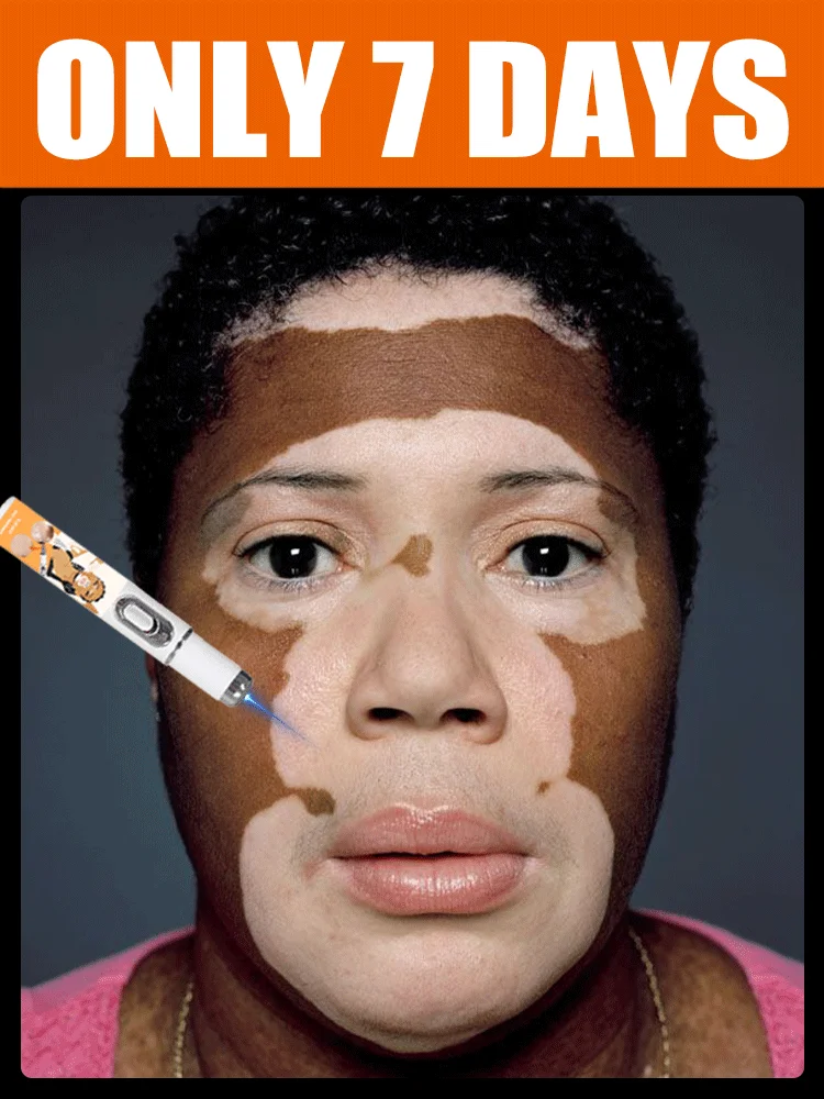 

ᴺᵉʷ ˡᵃˢᵉʳ ᵛⁱᵗⁱˡⁱᵍᵒ ʳᵉᵐᵒᵛᵃˡ ᵉᑫᵘⁱᵖᵐᵉⁿᵗ ⁱⁿ ²⁰²⁵ Blue laser care vitiligo