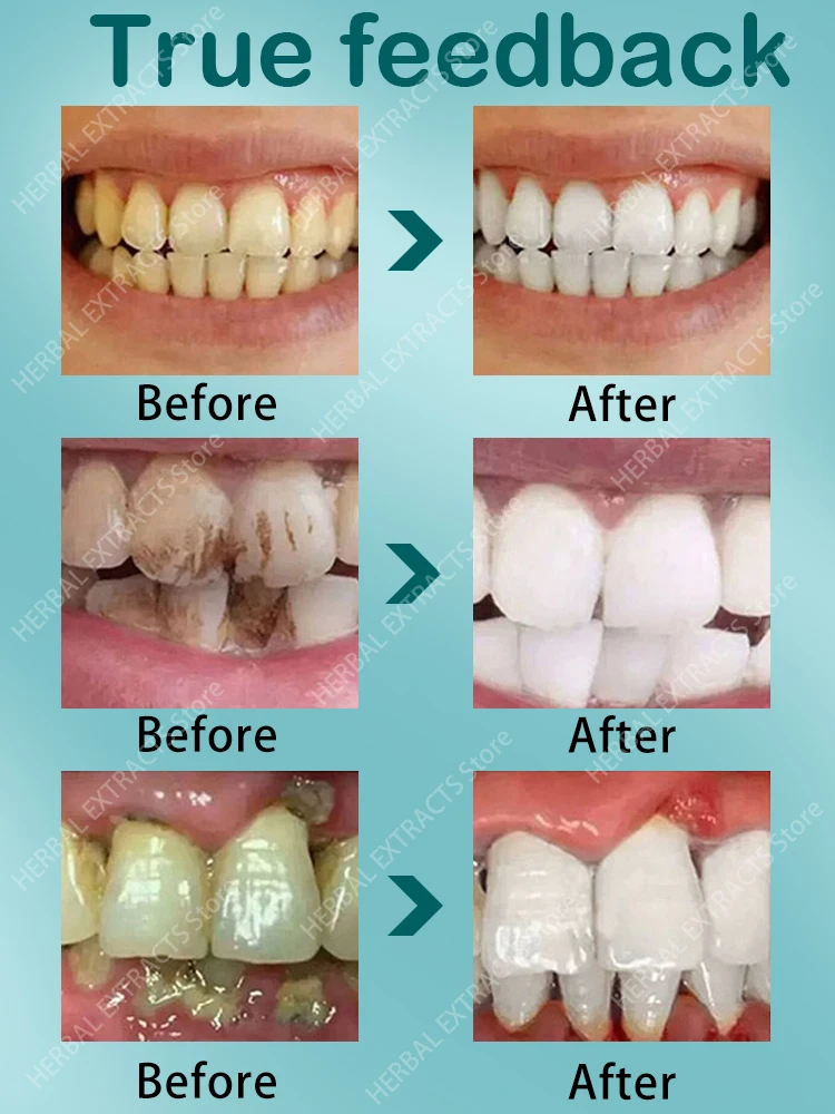 Teeth Whitening Toothpaste To Remove Stains and Debris.Protect Gum Health,Fresh Breath,Whiten Teeth.Tooth Color Corrector