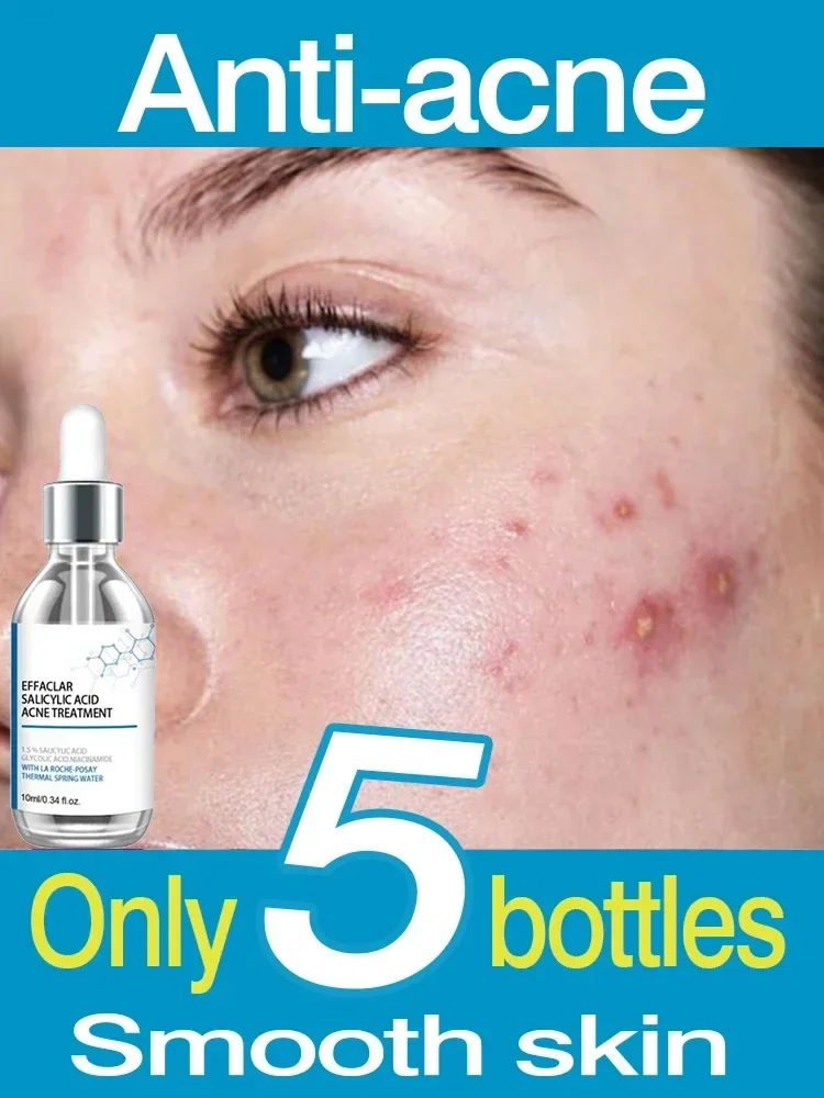 Herbs Acne Treatment Acne Remover Face Serum Pimple Remover Shrink Pores Oil Control Face Herb Acne Skin Care