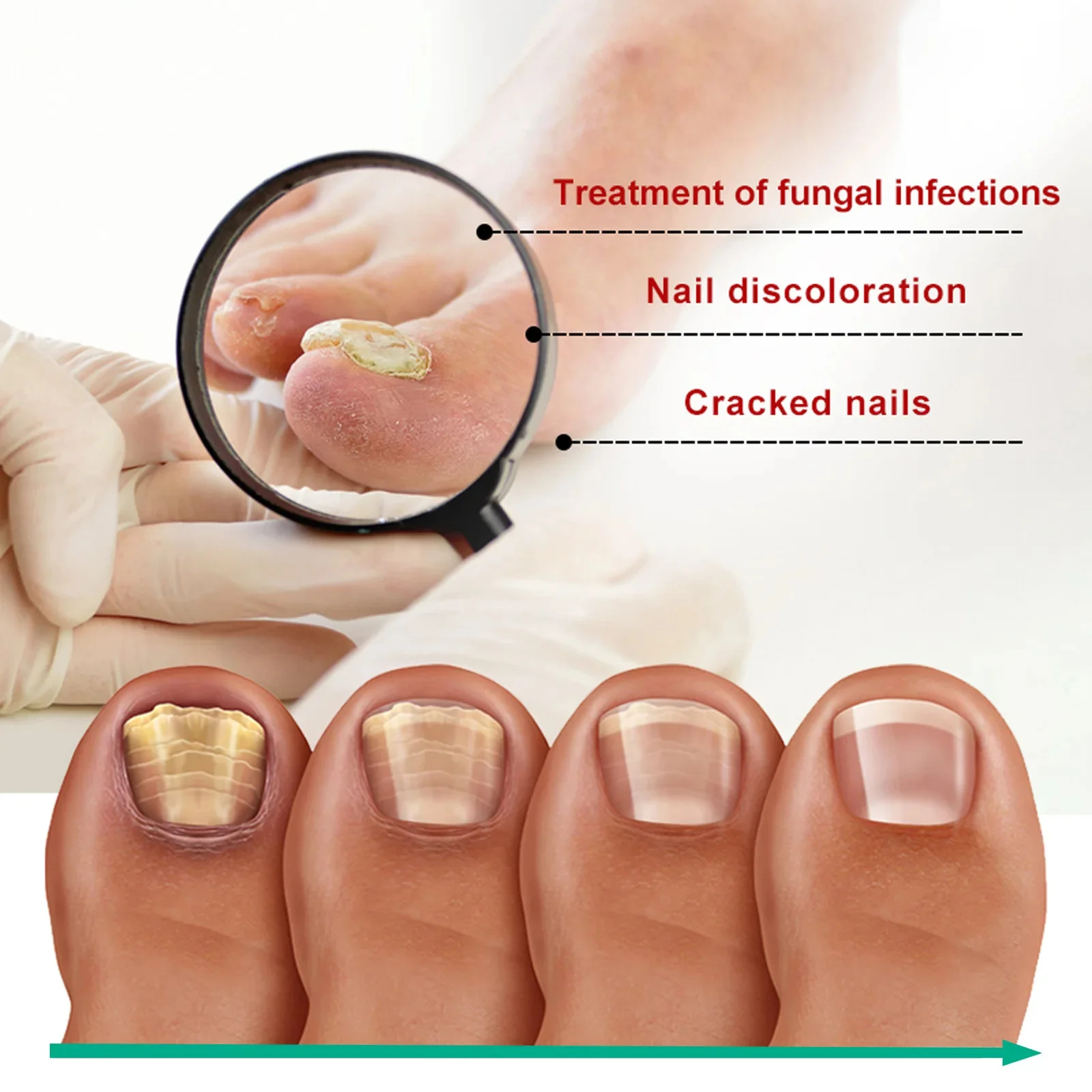 Nail Fungus Treatment Gel Herbal Nail Treatment Repairing Thickened Gray Nails Relieve Ingrown Nail Cleaning Anti Infection Care