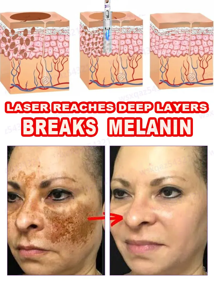 【Powerful and effective】Laser fights melanin! Make your skin fair and translucent