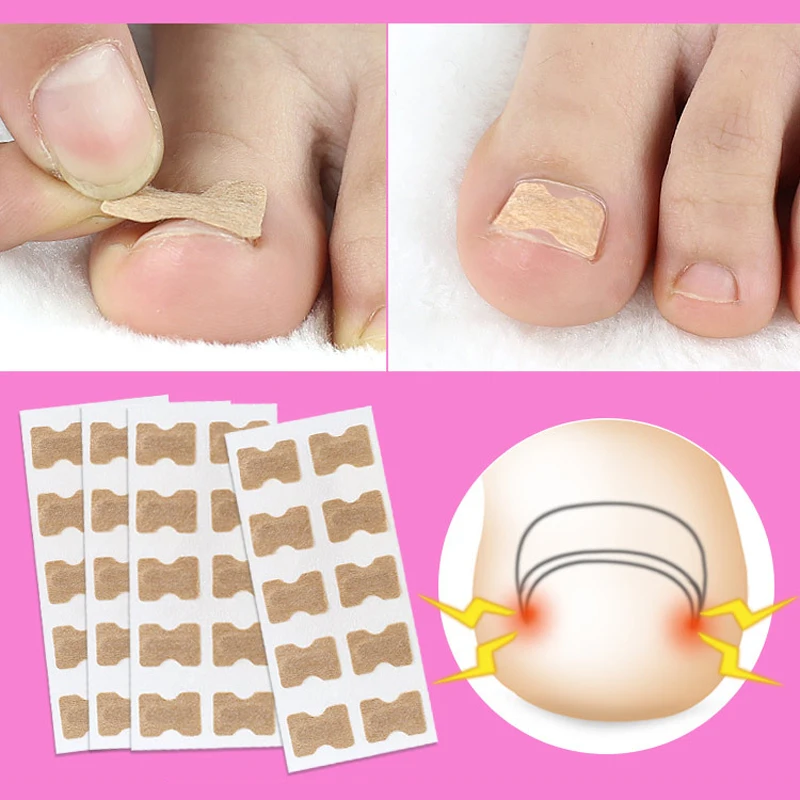 2Sheet Nail Feet Corrector Sticker Disposable Invisible Nail Toe Corrector Anti-Friction Pads Ingrown Toenail Corrector Patches