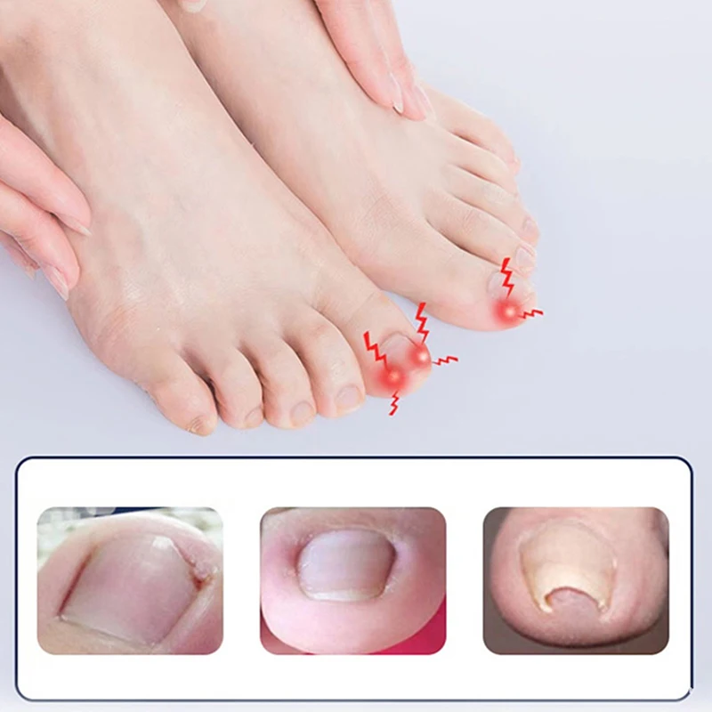 1 zestaw narzędzia do korekcji wrastających paznokci Pedicure odzyskaj osadzony paznokieć u nogi profesjonalna pielęgnacja stóp narzędzie do korekcji pielęgnacja stóp