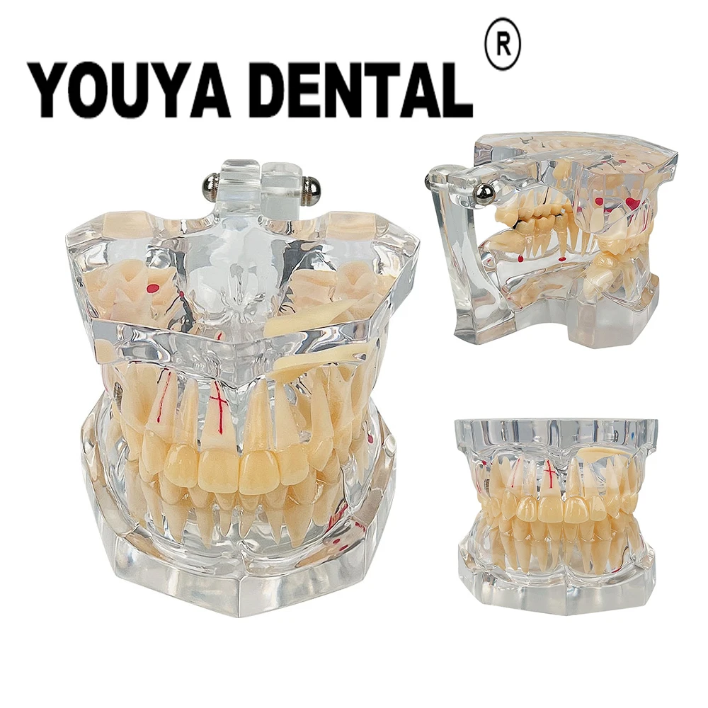 2.5 Times Transparent Pathological Model with Dental Caries for Dentist Student Practice Training Studying Oral Medical Model