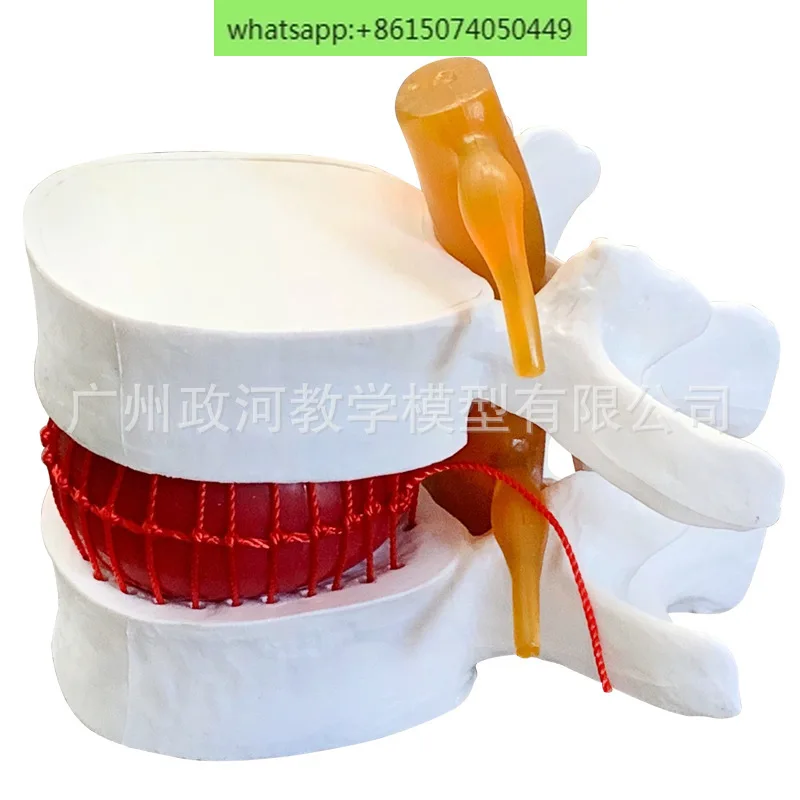 Medical human lumbar disc herniation demonstration model Lumbar spine lesion model Orthopedics Pathological lumbar herniation