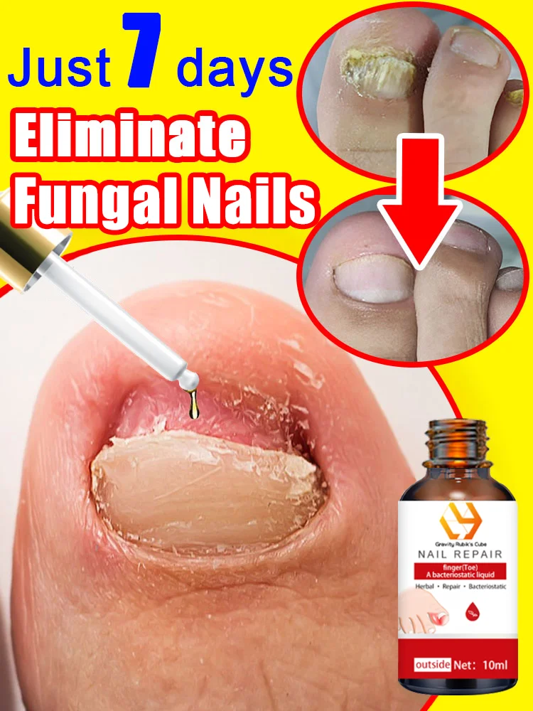 

Foot Nail troubles Solved completely