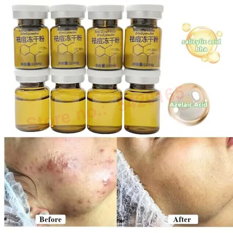 Salicylic Acid Freeze-Dried Powder Peptide Skin Booster  For Acne And Blackheads Deep Anti-Acne Clear Purifies Skin Serum