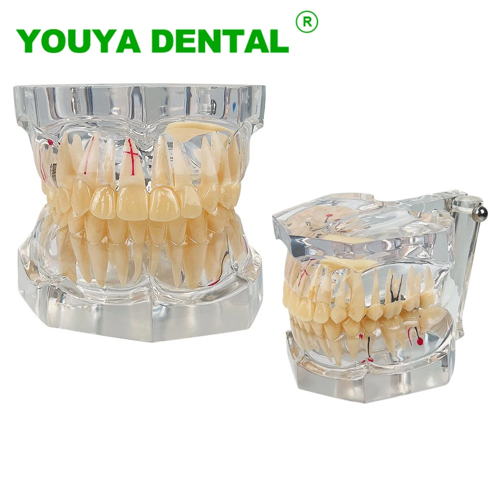 

Dental Pathology Teeth Model 2.5 Times Dentistry Teach Implant Model Dentist Student Training Education Demonstration Tools