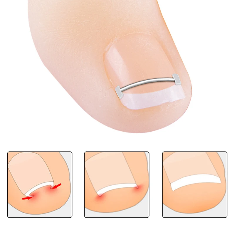 Ingrown toenailコレクターツール、ペディキュア回復、埋め込み式ネイルトリートメント、プロのつま先矯正、フットケアツール、10個