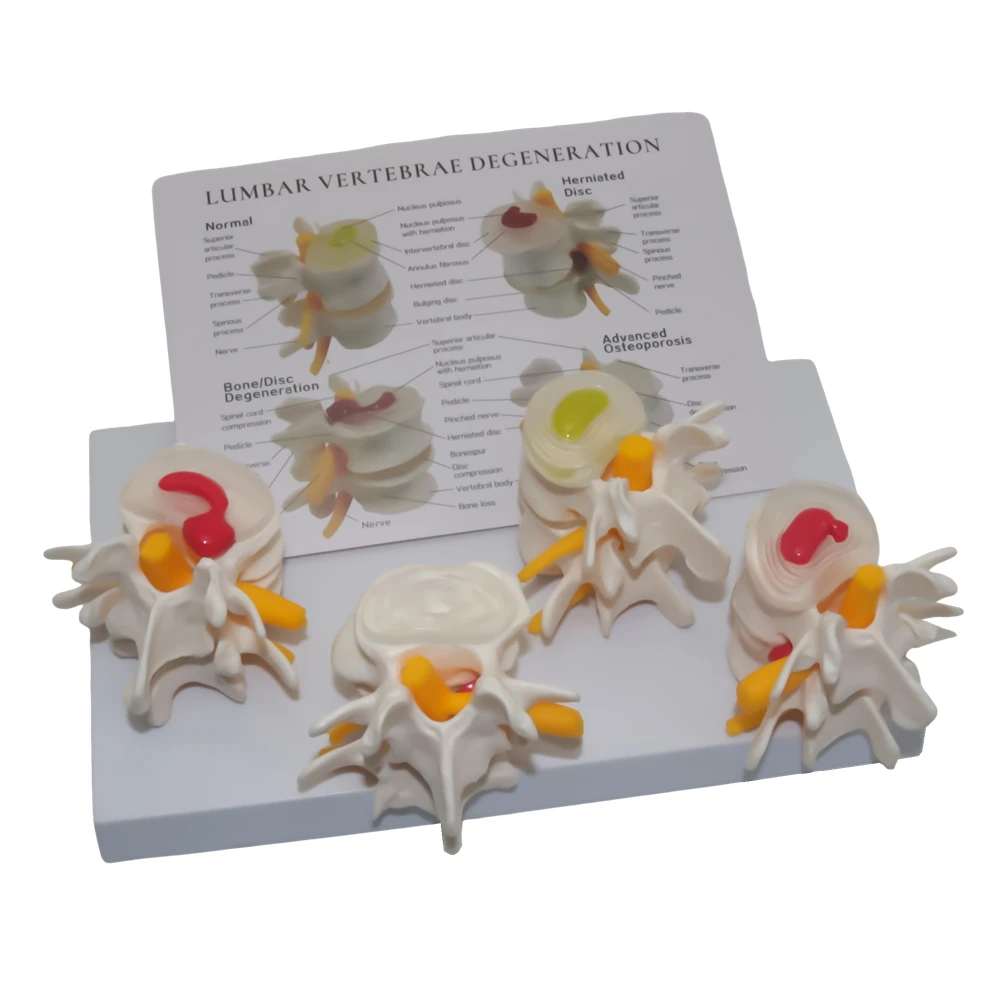 4-stage Pathological Lumbar comparative Model Bone Model For Human Body Teaching Equipment Student Lab Model Medical Teaching