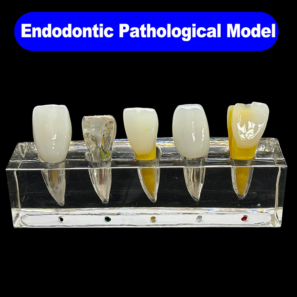 Modelo de dientes dentales, modelo de tratamiento endodóntico, modelo de tratamiento de conducto radicular, modelo Endo de odontología, Material de laboratorio