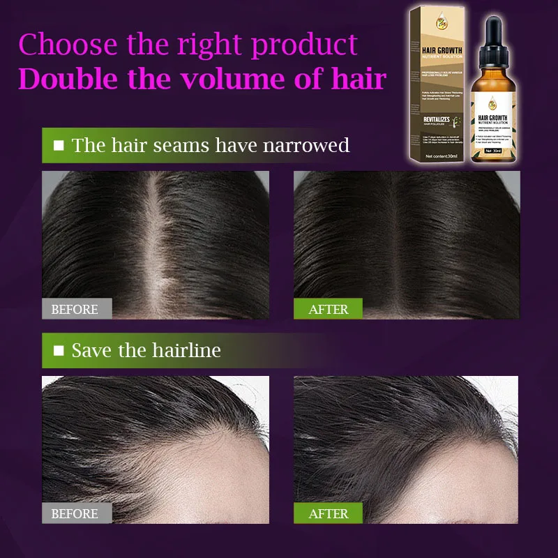 Biotin Fast Hair Growth Oil Hair Regrowth Serum Hair Thinning Treatment Hair Growth Liquid Anti-Hair Loss for Women amp Men