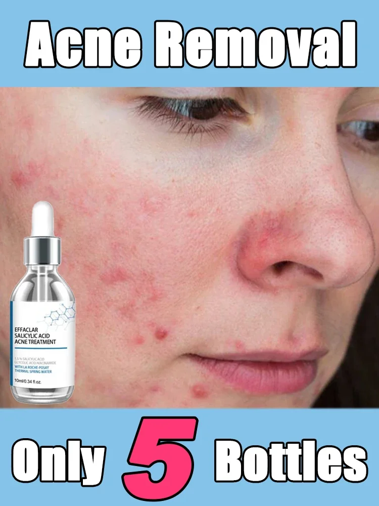 

Face Serum Fruit Acid Acne Treatment Oil Control Remove Blackheads Shrink Pores Skin Texture Improve Care