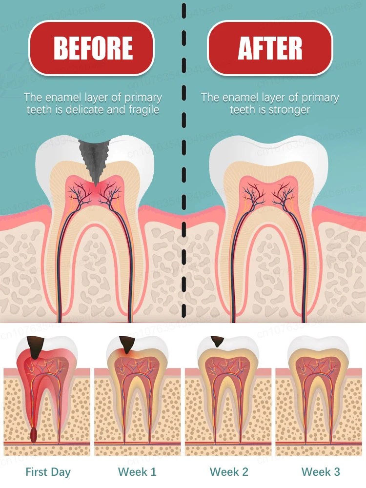 لا تمنح تجاويف صغيرة تصبح مشاكل كبيرة. معجون أسنان يمكنه إصلاح كافيت بدقة #3
