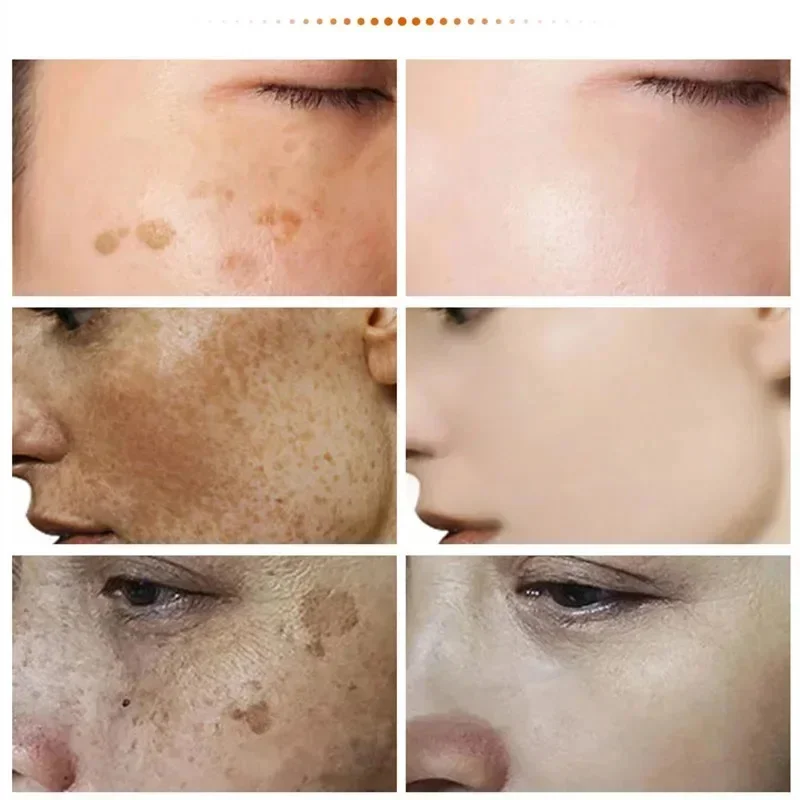 Kraftvolle flecken entfernende Weiß creme hellt die Haut schnell auf und beseitigt Melanin pigmentierung Melasma dunkle Flecken befeuchten Schönheits gel