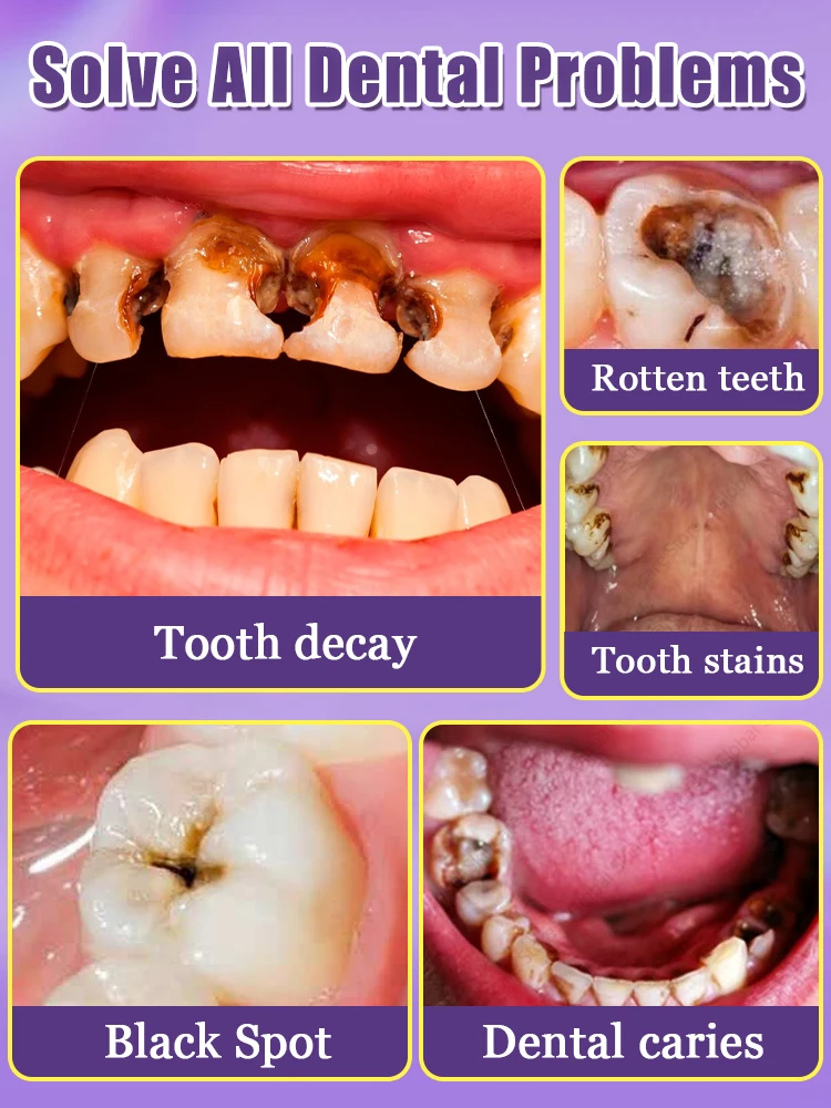 Dentes Decay reparação