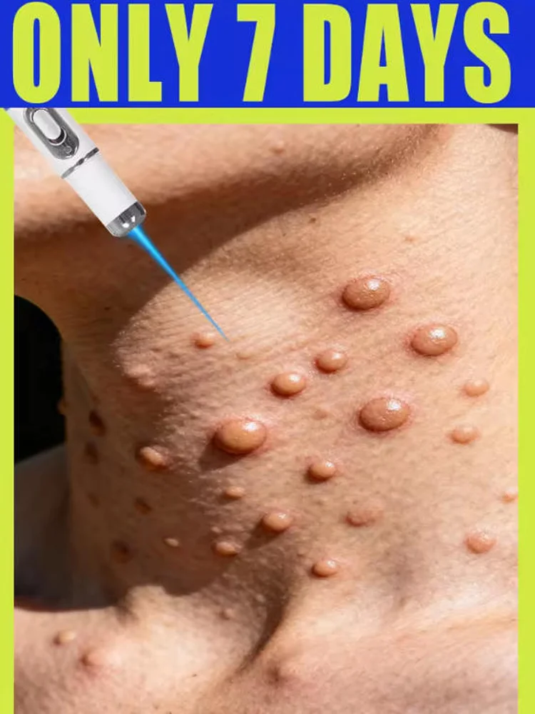 

Generation-3 Laser Says Goodbye To all warts