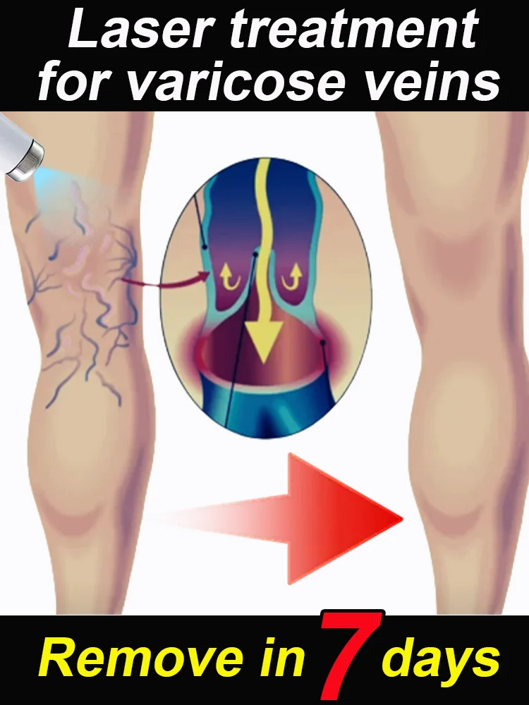 

Varicose vein laser pen second generation upgrade to promote blood circulation
