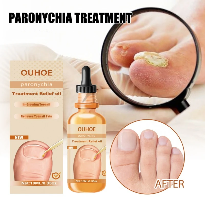 Anti-nail groove relief Essential oil repair ingrown toenail onychomycosis Fungal Treatment thickening soft nails Infection care