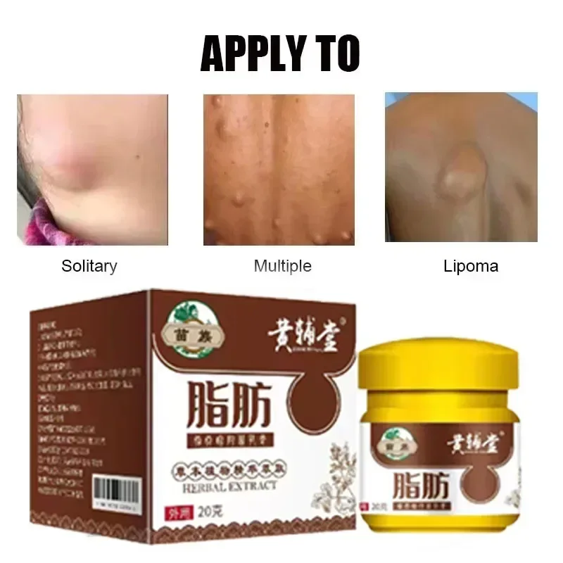 

02Lipoma Removal Cream Relief Swelling Fat Elimination Cream Remove Subcutaneous Lump Extract Care Fat Bulges Lump