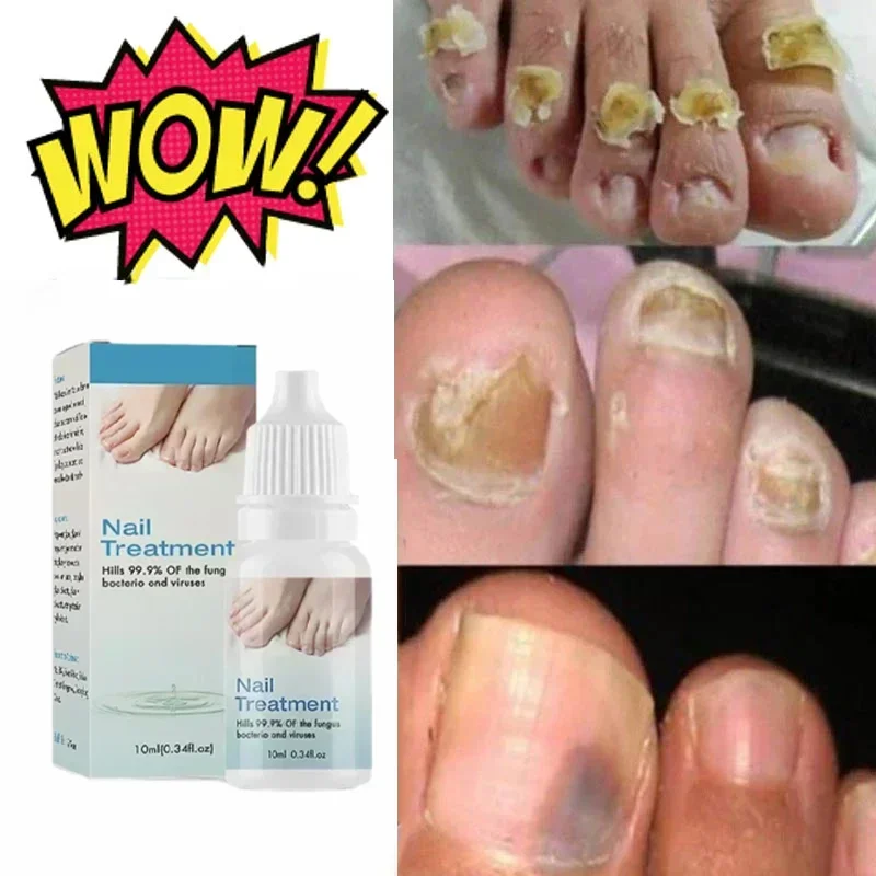 10ml Onychomycosis Reparatie Serumzalf Onychomycosis Paronychia Creen Nagel Teennagel การซ่อมแซมด้วยแสง Essence