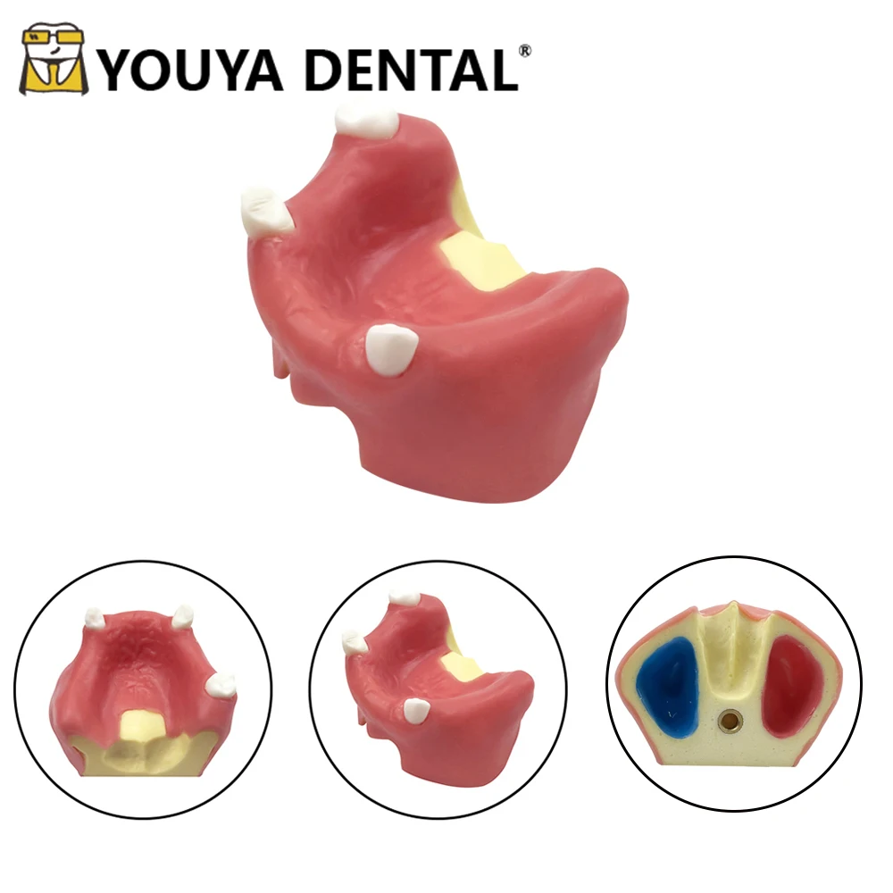 1PCS Dental Model Teeth Implant  Missing Teeth Practice Model Tooth Dental Implant Model Training Practice Oral Teaching Models