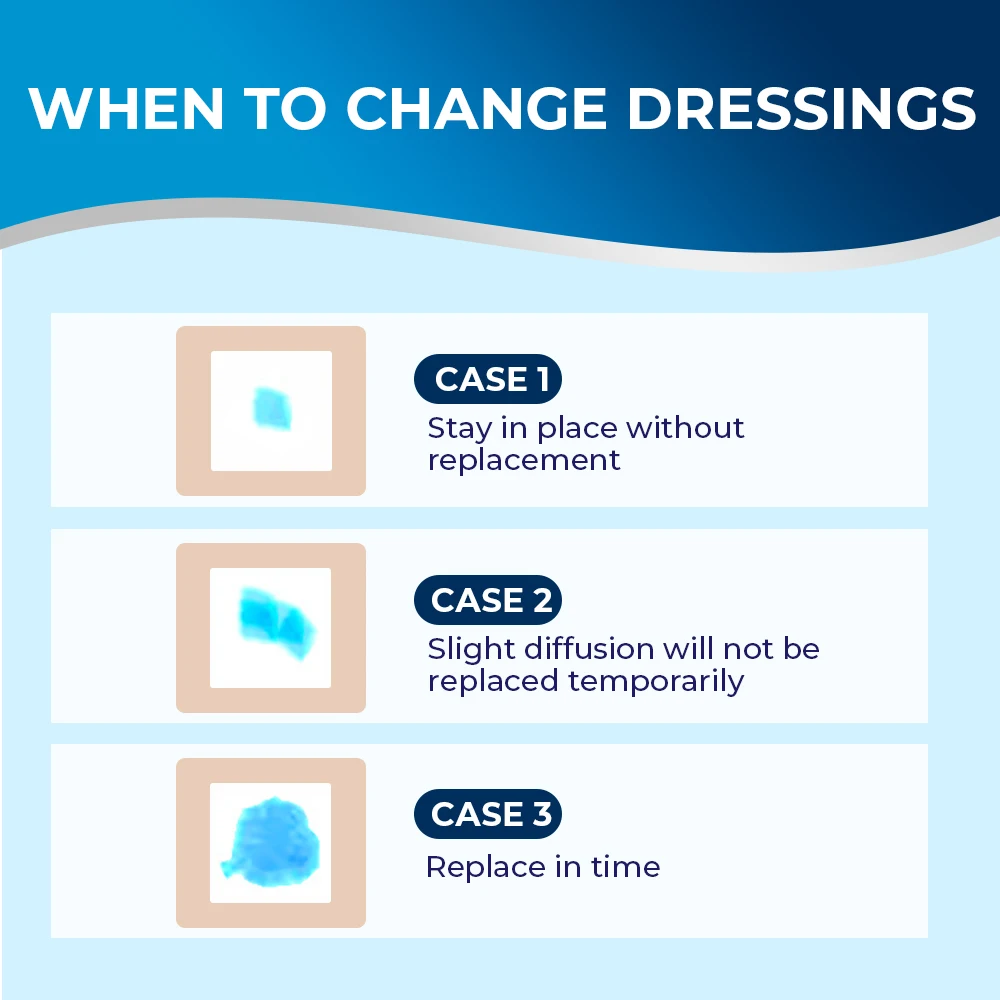 5 قطعة رغوة السيليكون خلع الملابس مقاوم للماء مضاد للجراثيم مكافحة العدوى لينة الجلد ودية Sacrum لاصق خلع الملابس المنزل الإسعافات الأولية #6
