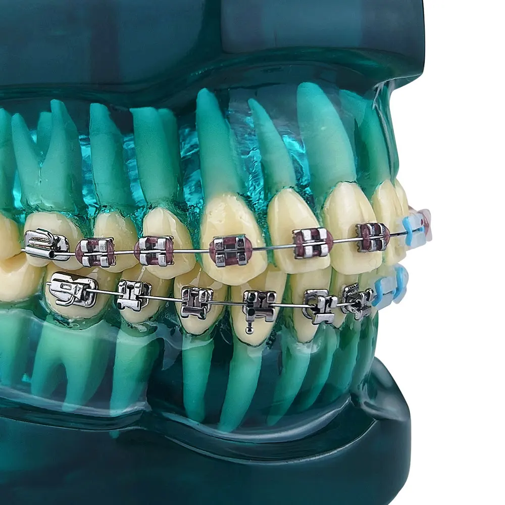 Orthodontic Teeth Model With Self Ligating Metal Ceramic Braces Bracket For Patient Communication Dental Treatment demo Model