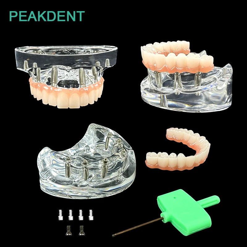 

Dental Removable Implant Model Dental Teaching Demonstration Of Maxillary Covered Dentures With 4 Implants
