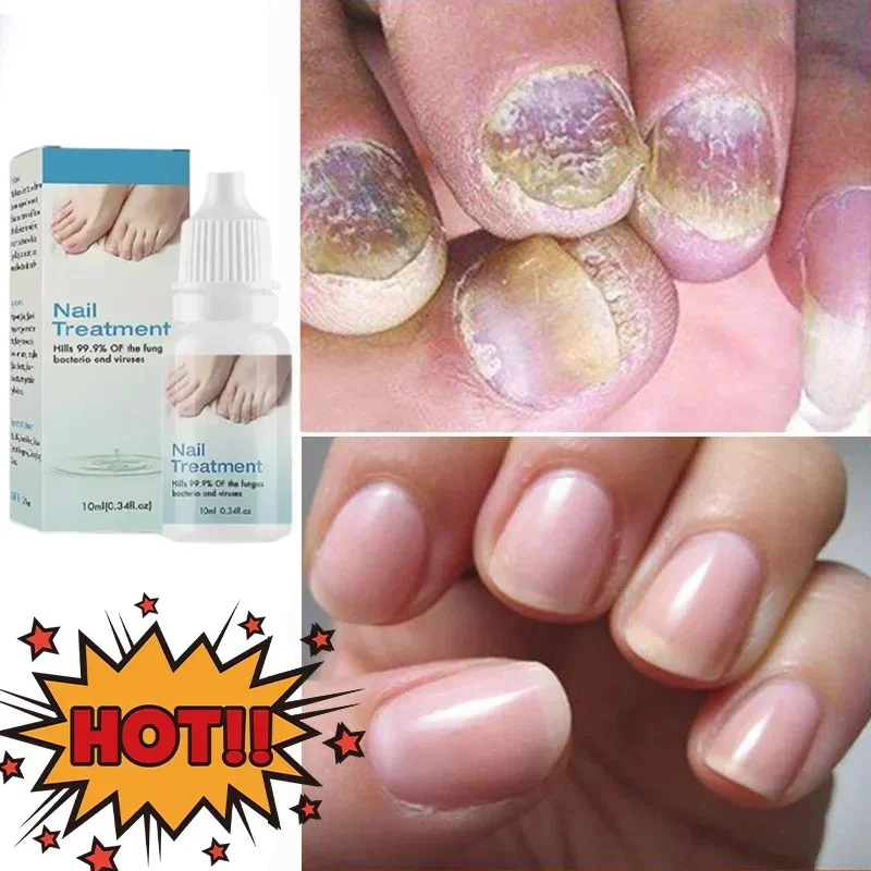 Traitement Antifongique des Ongles Incarnés, Soins des Pieds, Essence Anti betection, ParonyamieOnychomycose