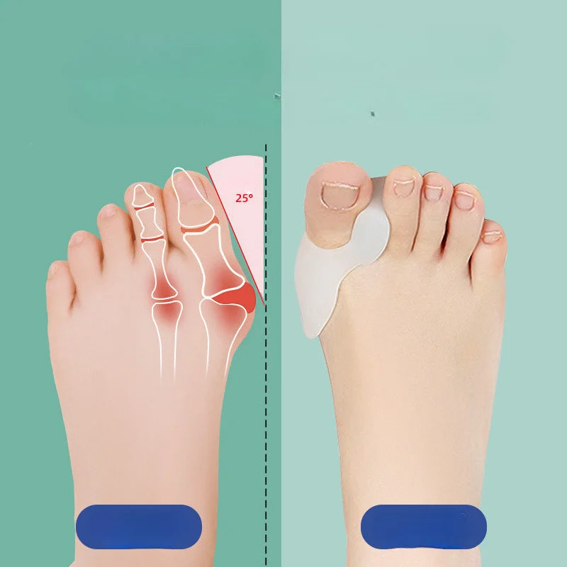 Toe Corrector Separator for Bunions Silicone Orthotic Insole with Toe Spacers, Hallux Valgus Splint for Overlapping Toes Relief