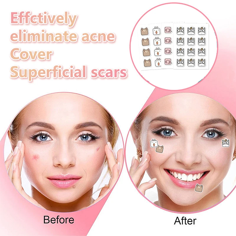 60pcs Cute Cartoon Cow Acnes Care Patch Pimple Spots Treatment Gentle Breathable Soothing Invisible Facial Care Sticker