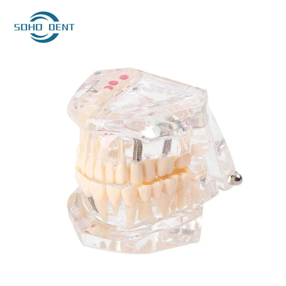 Dental Teeth Repair Model Disease Teeth Model for Dentist Student Practice Training Studying Oral Medical Dentistry Tools