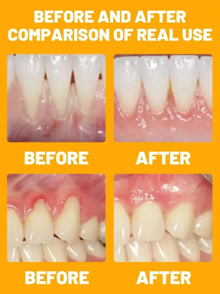 Soro De Gomas De Reparação Rápida, Creme Dental De Limpeza Dental, Remove Alergia, Eficaz, Remove Alergia, Cárie, Dental, Cárie