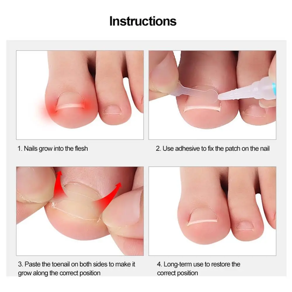 Correção do prego adesivo para unhas encravadas, pedicure patch, correção ortótica, comprimidos, ferramentas