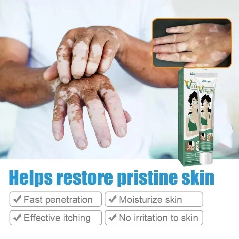 Vitiligo Ointment Herbal Extract Remove Ringworm White Spot Removal Skin Vitiligo Eliminate Vitiligo Treatment Cream