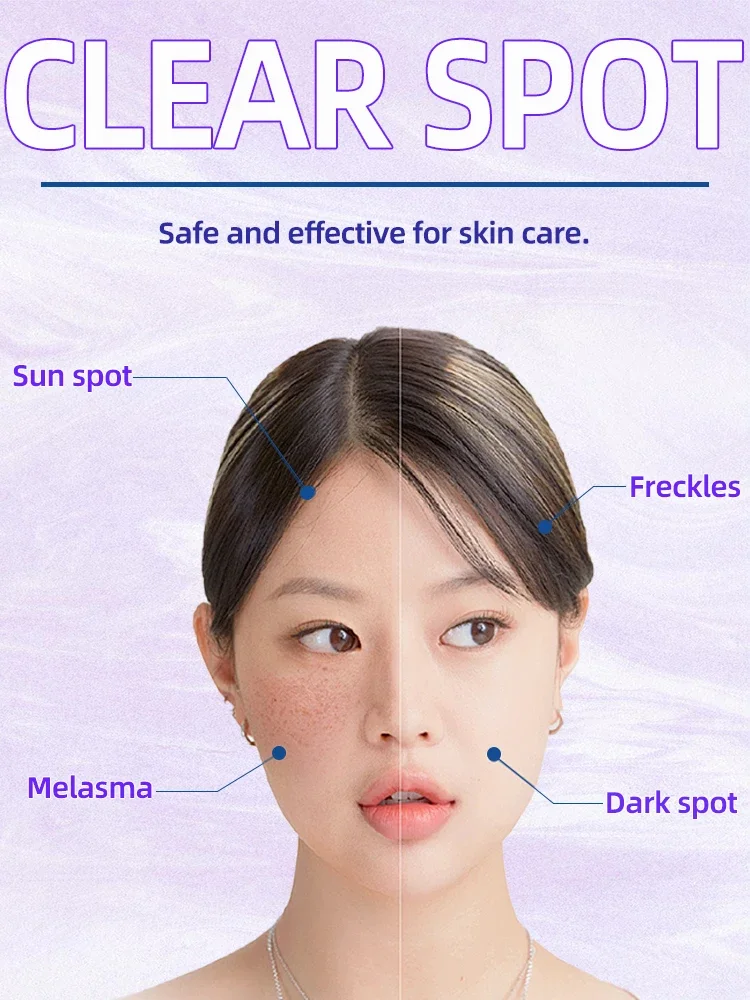 Chloasma Sun Dark Age Spot Freckles