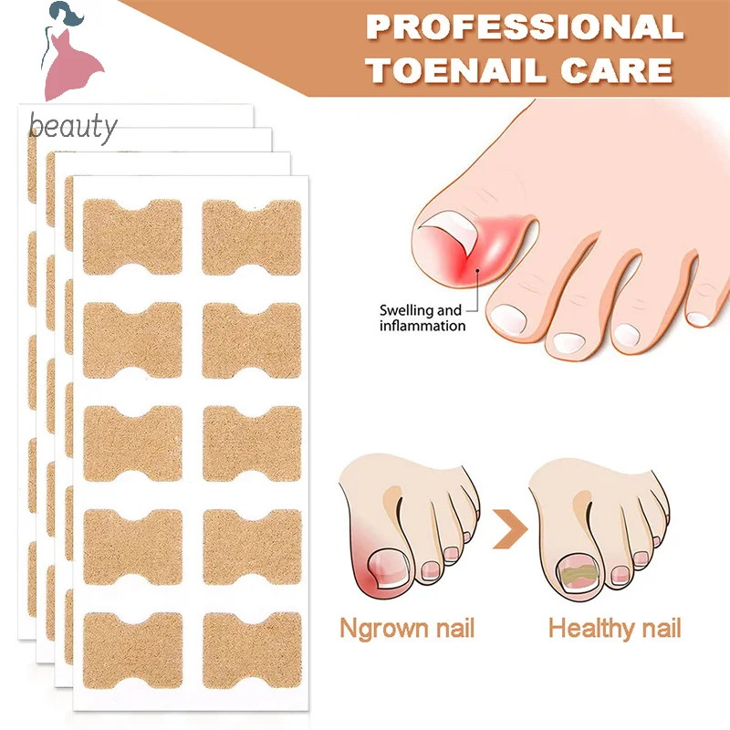 Ingrown Correção de Unhas Adesivos, Unha Corretor Patches, Tratamento Paroníquia, Recuperar, Ferramenta Pedicure Care, 60Pcs