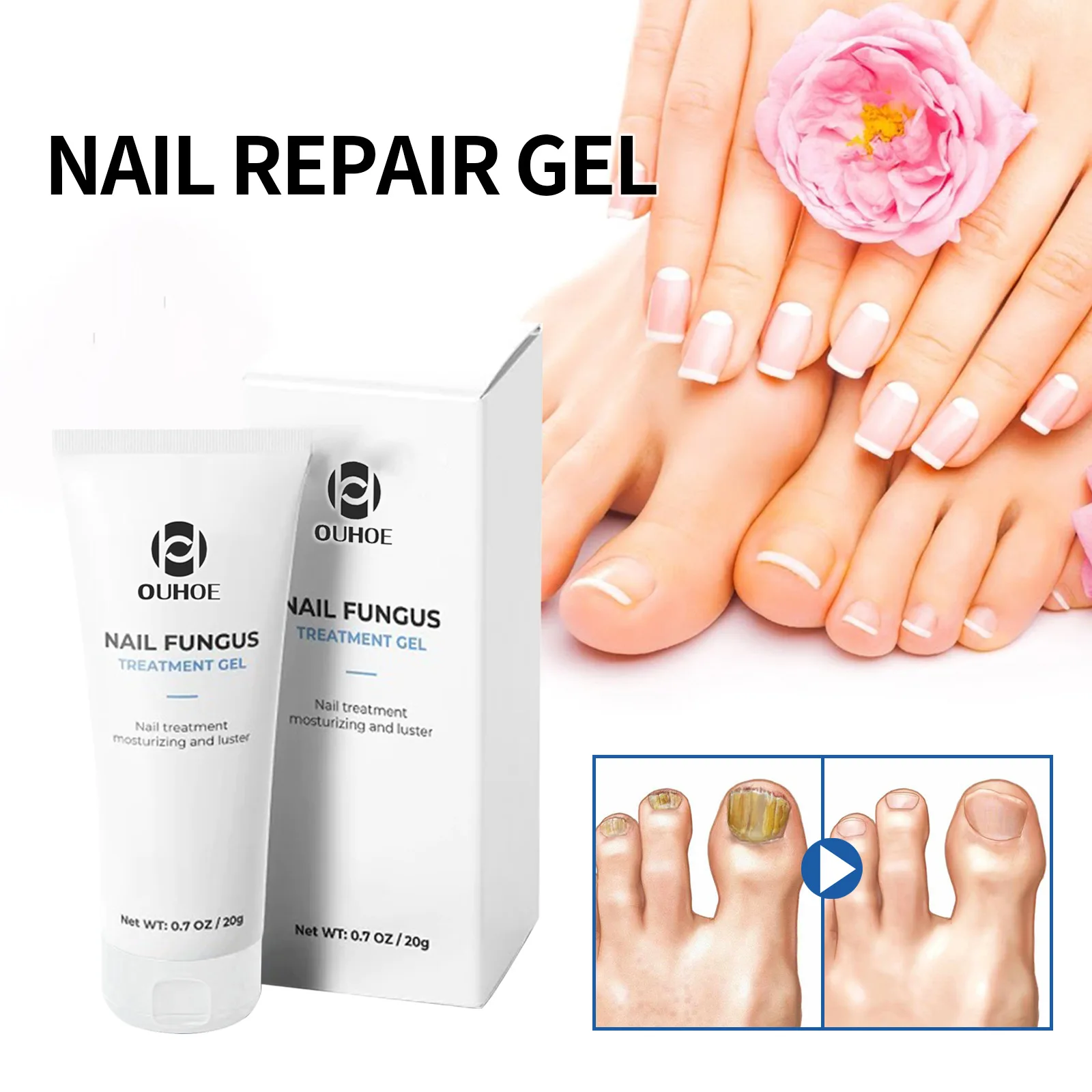 Nail Fungal Treatment Serum Onychomycosis Paronychia Anti Infection Toe Fungus Hand Foot Removal Repair Gel Care Beauty Health