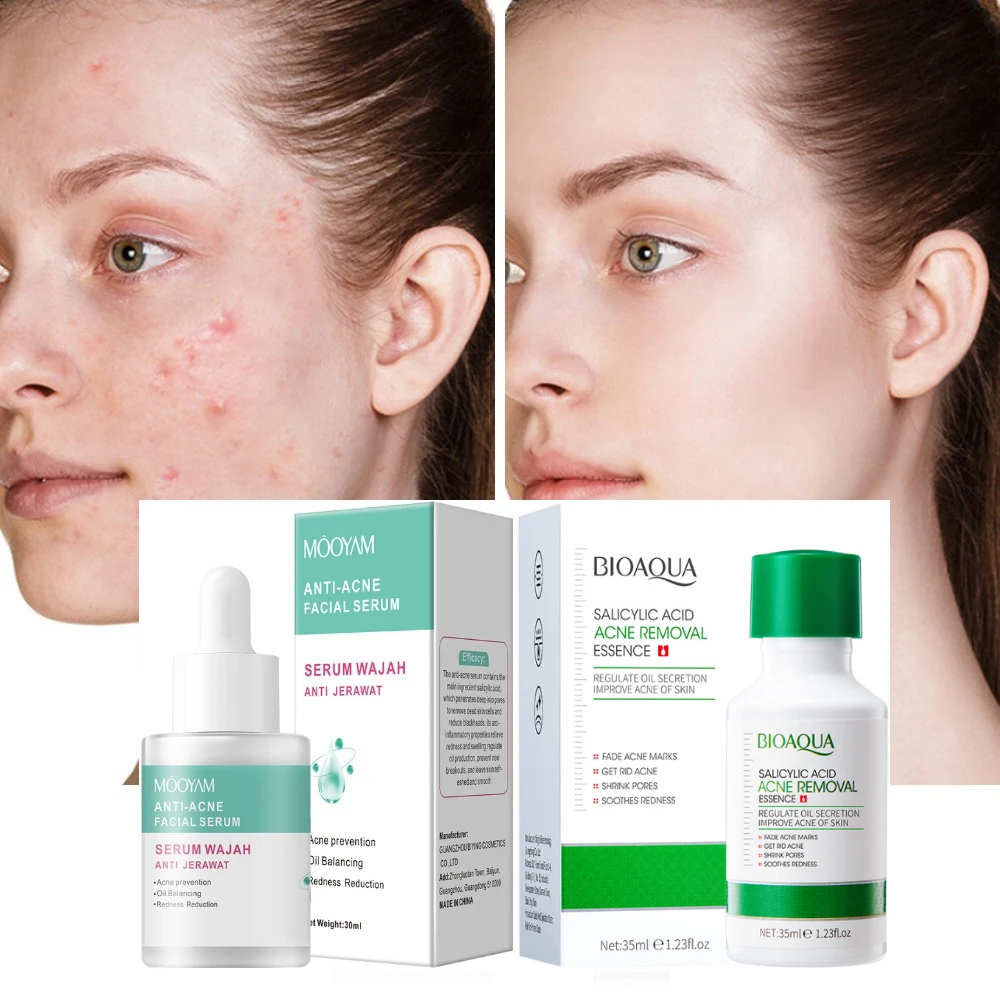 ANTI-ACNE FACIAL SERUM Salicylic Acid Moisturizing Acne Serum Soothing Acne Marks Beauty Serum Acne Treatment