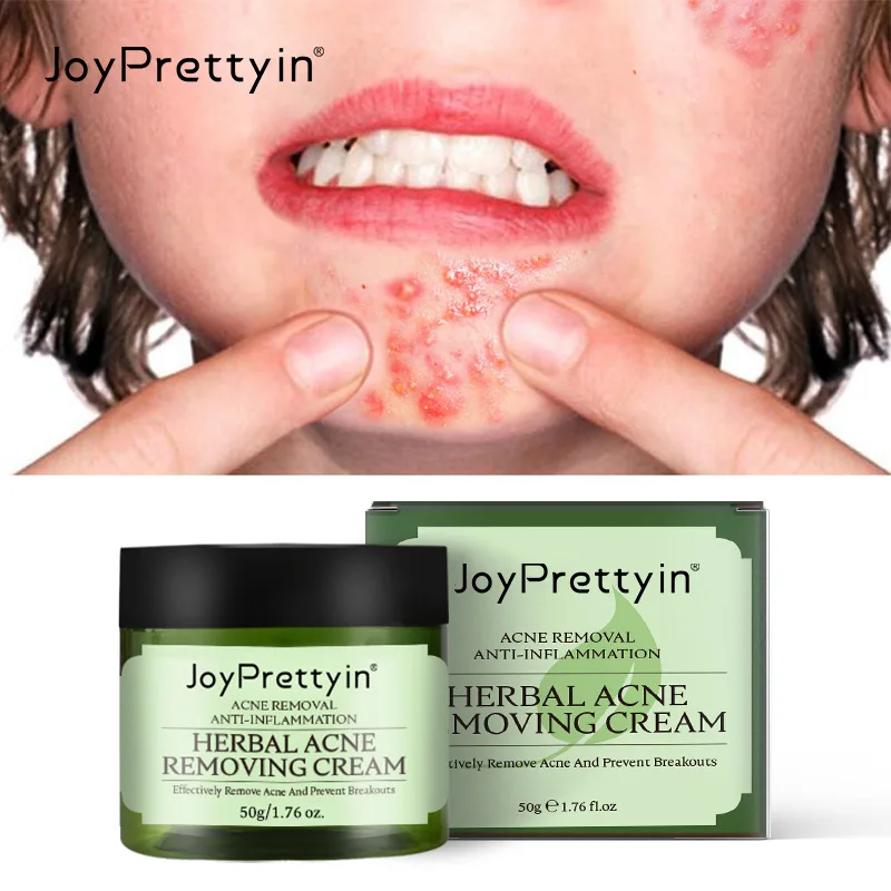 Herbal Acne Removing Cream Anti-Acne Repair Damaged Skin Brighten Gentle FormulaWhitehead Remover Fade Acne Scars Acne Repair