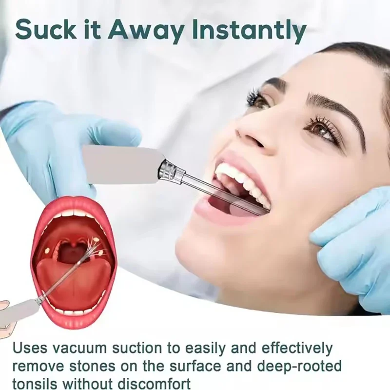 Nieuwe Elektronische Tonsil Steenzuiger Voor Mondverzorging, Vacuümsteenreinigingsset En Instant Zuiggereedschap Om De Mondgezondheid Te Verbeteren