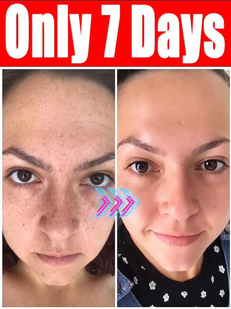 

Rᴇᴍᴏᴠᴇ ᴠᴀʀɪᴏᴜs sᴘᴏᴛs Dark patches disappear, bringing back your flawless skin’s radiance. Skin care tools