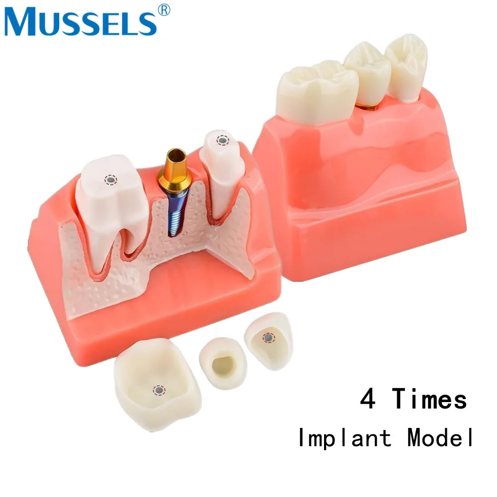نموذج زرع الأسنان ، جسر التاج القابل للإزالة ، مختبر عرض تعليمي ، 4 مرات ، 6 مرات ، نماذج الدراسة