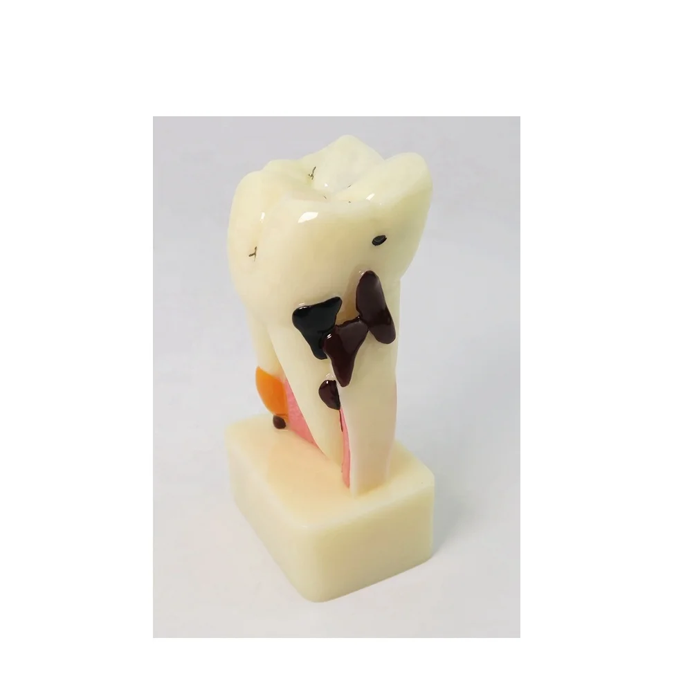 4-voudig Cariësdemonstratie Model Tandmodel