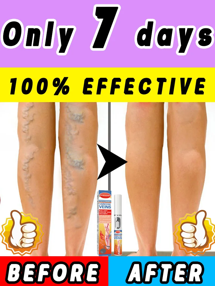 

Remove varicose veins in 7 days